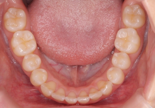 歯を抜かないで出っ歯を治したいの治療中