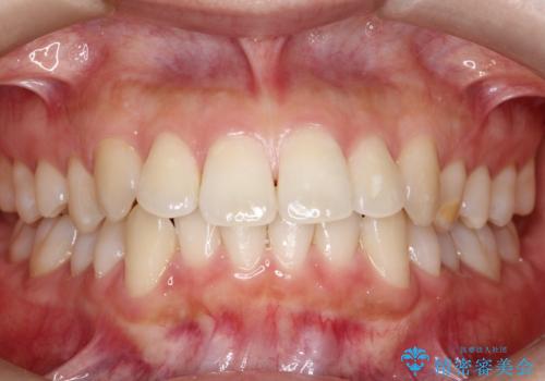 【審美装置】抜歯矯正で口元を改善の症例 治療前