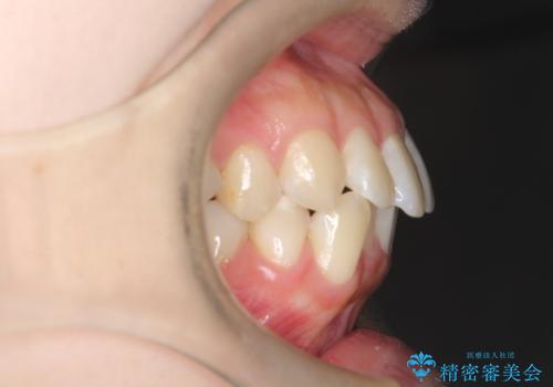 【審美装置】抜歯矯正で口元を改善の治療前