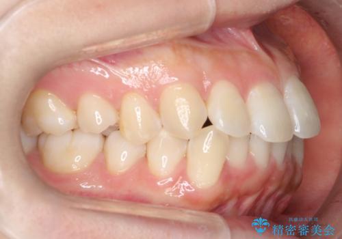 【審美装置】抜歯矯正で口元を改善の治療前