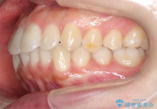 【審美装置】抜歯矯正で口元を改善の治療前