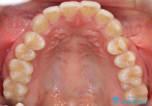 【審美装置】抜歯矯正で口元を改善の治療前