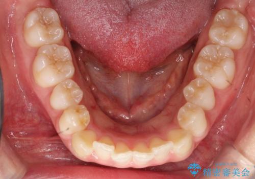 【審美装置】抜歯矯正で口元を改善の治療前