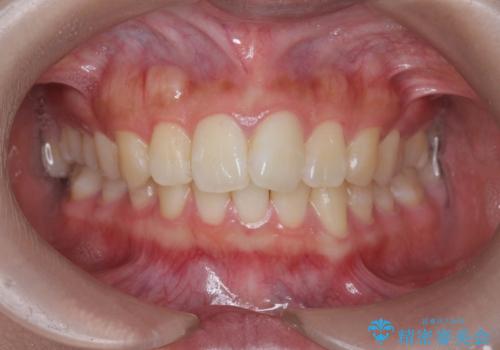 [ ワイヤー小矯正+マウスピース矯正 ]  前歯のねじれを短期間で治したいの症例 治療前