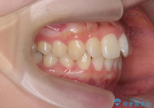 [ ワイヤー小矯正+マウスピース矯正 ]  前歯のねじれを短期間で治したいの治療前
