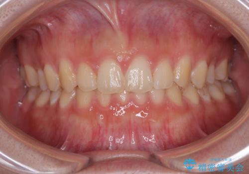 前歯のすきっ歯を治したい　インビザラインによる矯正治療