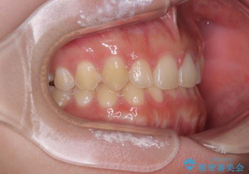 前歯のすきっ歯を治したい　インビザラインによる矯正治療の治療後
