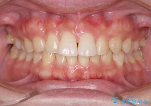 【審美装置】前歯をきれいにしたいの治療前