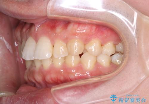 【審美装置】前歯をきれいにしたいの治療前