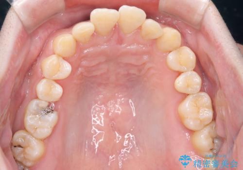 【審美装置】前歯をきれいにしたいの治療前