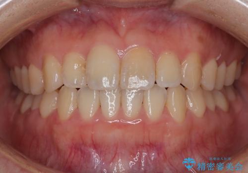 【インビザライン】前歯のがたつきを目立たない装置で治療の症例 治療後