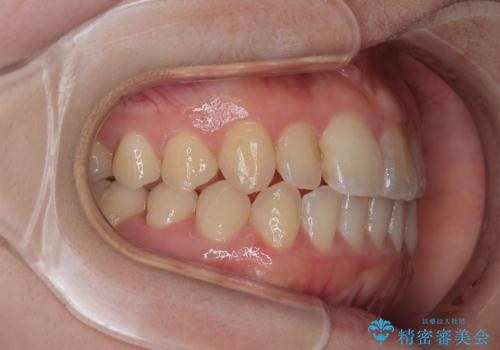 【インビザライン】前歯のがたつきを目立たない装置で治療の治療後