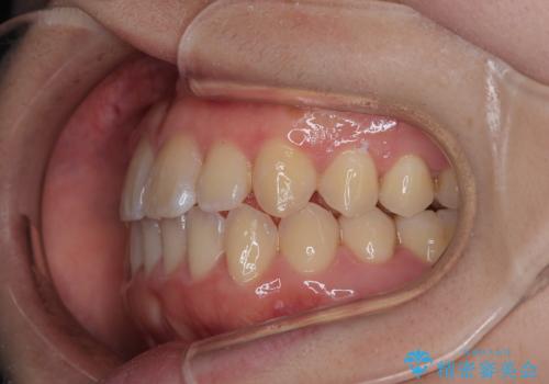【インビザライン】前歯のがたつきを目立たない装置で治療の治療後