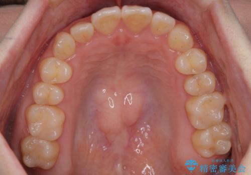 【インビザライン】前歯のがたつきを目立たない装置で治療の治療後