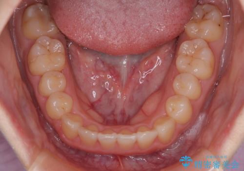 【インビザライン】前歯のがたつきを目立たない装置で治療の治療後