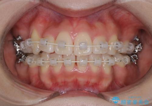 【ワイヤー矯正】オープンバイトを治したいの治療中