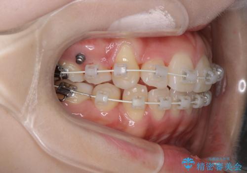 【ワイヤー矯正】オープンバイトを治したいの治療中