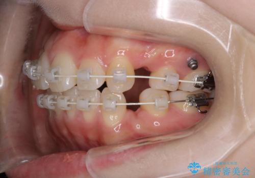 【ワイヤー矯正】オープンバイトを治したいの治療中