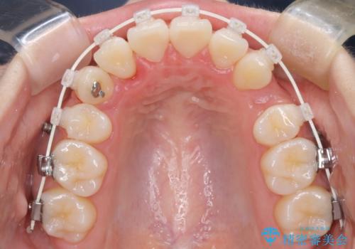 【ワイヤー矯正】オープンバイトを治したいの治療中