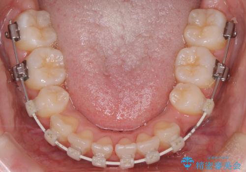 【ワイヤー矯正】オープンバイトを治したいの治療中