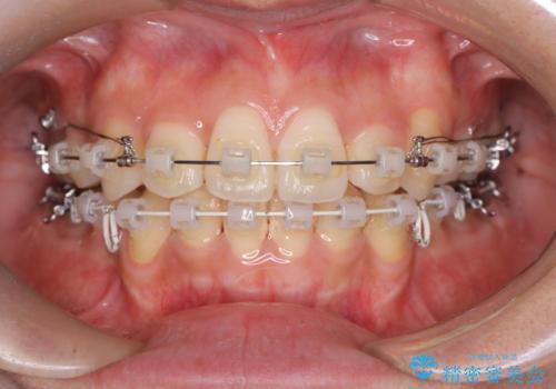 【クリア装置】八重歯の矯正治療の治療中