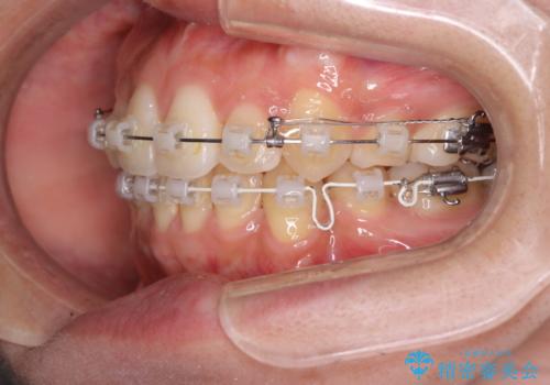 【クリア装置】八重歯の矯正治療の治療中