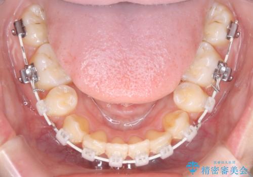 【クリア装置】八重歯の矯正治療の治療中