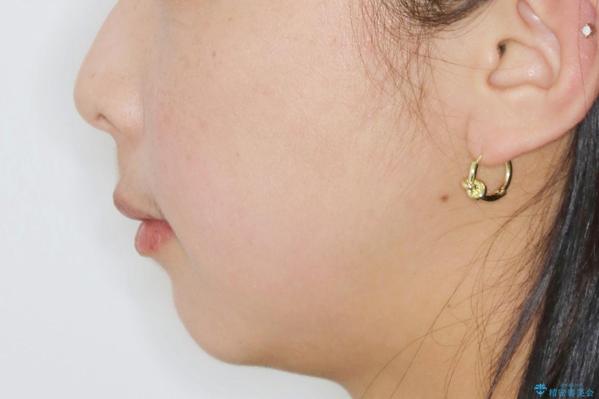 【抜歯】ワイヤー装置で綺麗な歯並び!口元も劇的変化の治療後(顔貌)