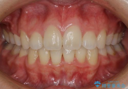 【抜歯】ワイヤー装置で綺麗な歯並び!口元も劇的変化の症例 治療後