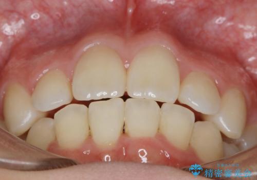 【抜歯】ワイヤー装置で綺麗な歯並び!口元も劇的変化の治療後