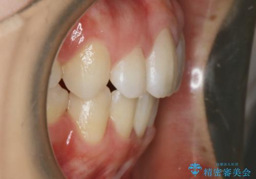 【抜歯】ワイヤー装置で綺麗な歯並び!口元も劇的変化の治療後