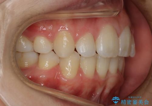 【抜歯】ワイヤー装置で綺麗な歯並び!口元も劇的変化の治療後