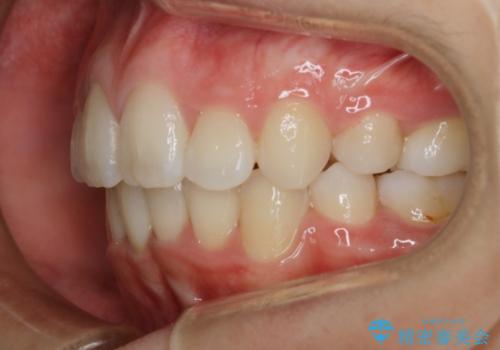 【抜歯】ワイヤー装置で綺麗な歯並び!口元も劇的変化の治療後