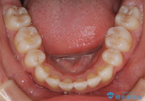 【抜歯】ワイヤー装置で綺麗な歯並び!口元も劇的変化の治療後