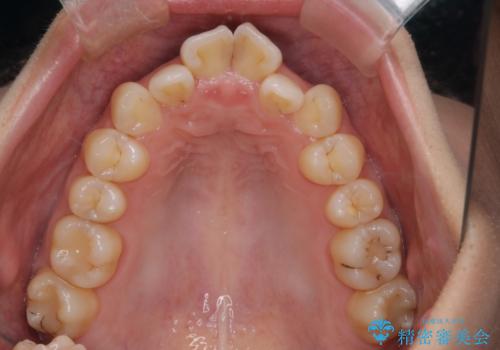 【ワイヤー矯正】前歯のがたつきを短期間で治したいの治療前