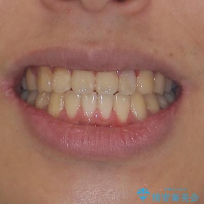 クロスバイトを楽して治す ワイヤー装置にて矯正治療の治療後(顔貌)