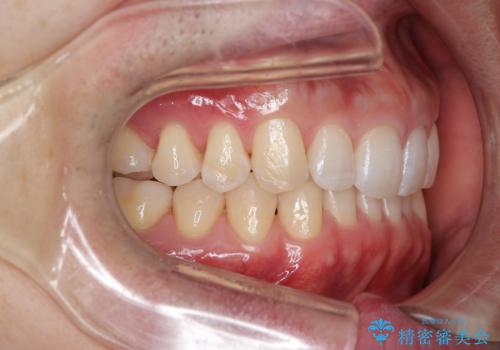 【インビザライン】すきっぱを治したいの治療後