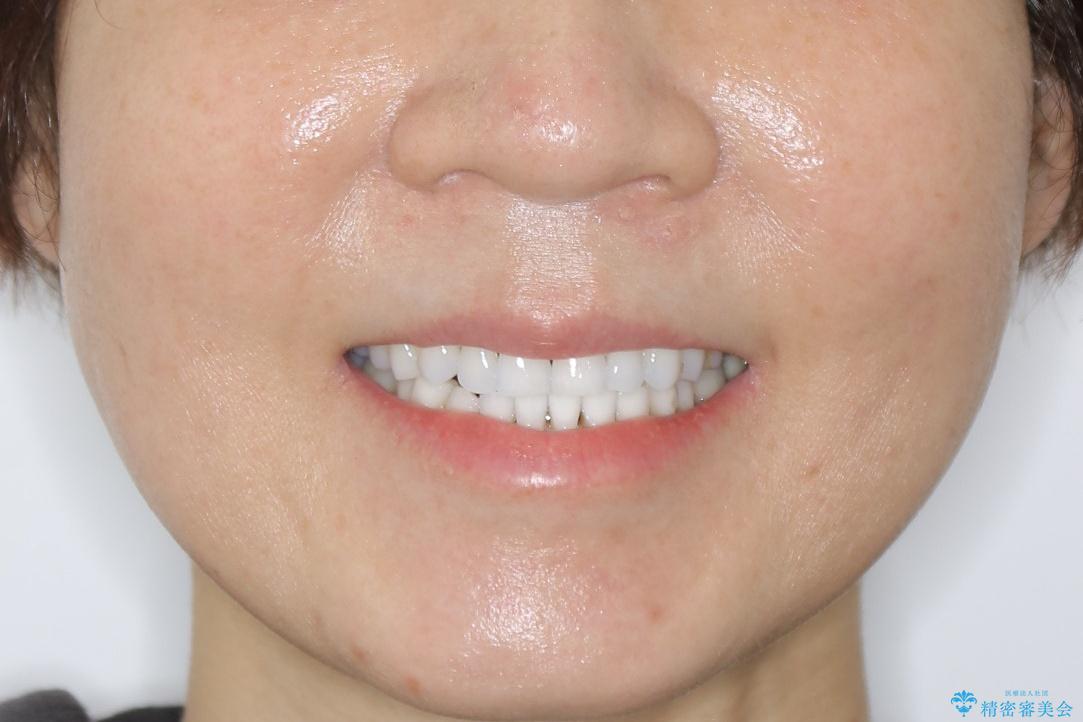 【非抜歯】マウスピースでオープンバイトを治すの治療後(顔貌)