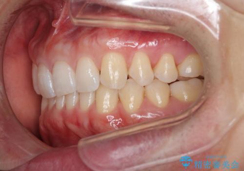 【インビザライン】すきっぱを治したいの治療後