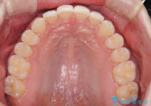 【インビザライン】すきっぱを治したいの治療後