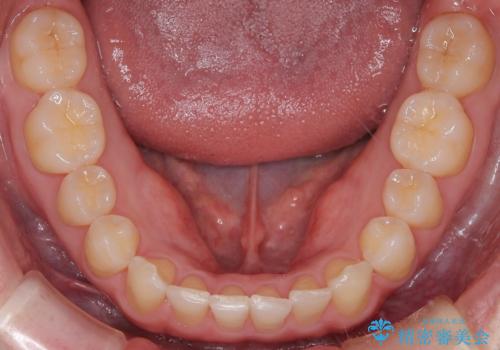 【インビザライン】すきっぱを治したいの治療後