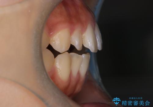 【インビザライン】がたつきをマウスピースできれいにしたいの治療前