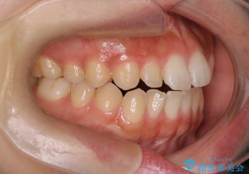 【インビザライン】がたつきをマウスピースできれいにしたいの治療前