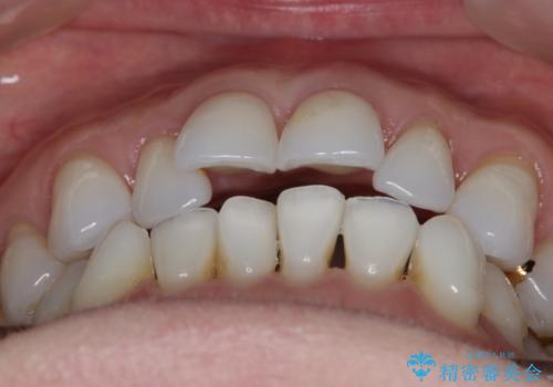 【非抜歯】マウスピースでオープンバイトを治すの治療前