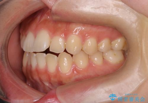 【インビザライン】がたつきをマウスピースできれいにしたいの治療前