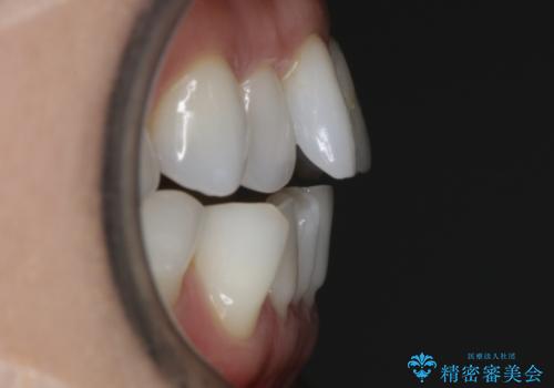 【非抜歯】マウスピースでオープンバイトを治すの治療前