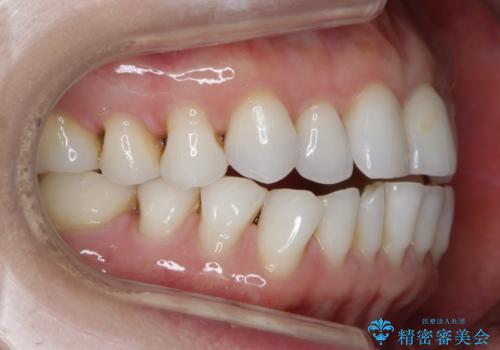 【非抜歯】マウスピースでオープンバイトを治すの治療前