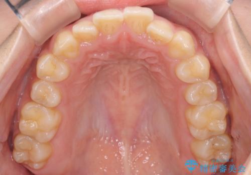 【インビザライン】がたつきをマウスピースできれいにしたいの治療前