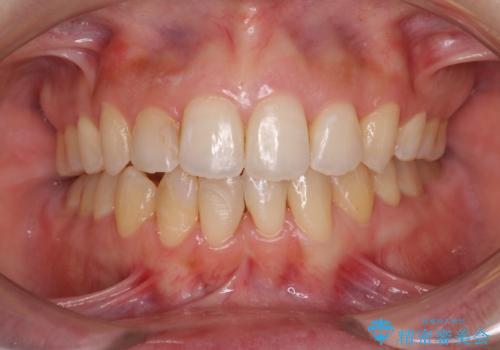 後戻りの再矯正 ワイヤー装置でデコボコと隙間を改善の症例 治療後