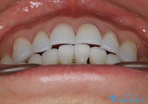 【非抜歯】マウスピースでオープンバイトを治すの治療後